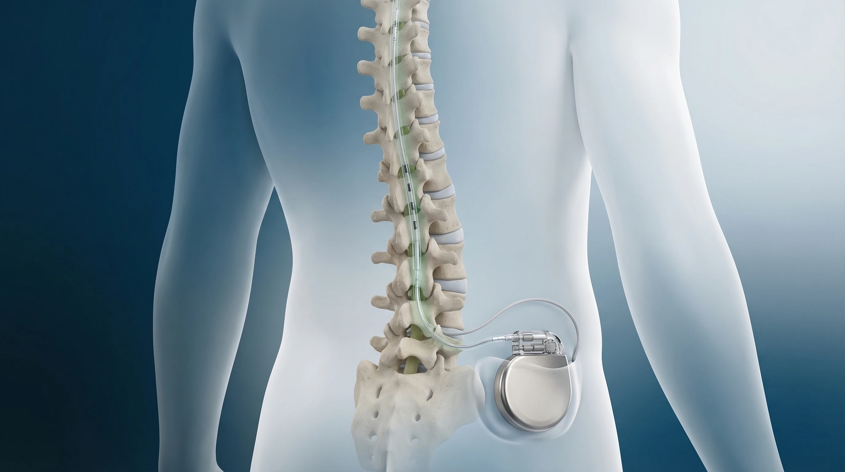 Estimulação Medular